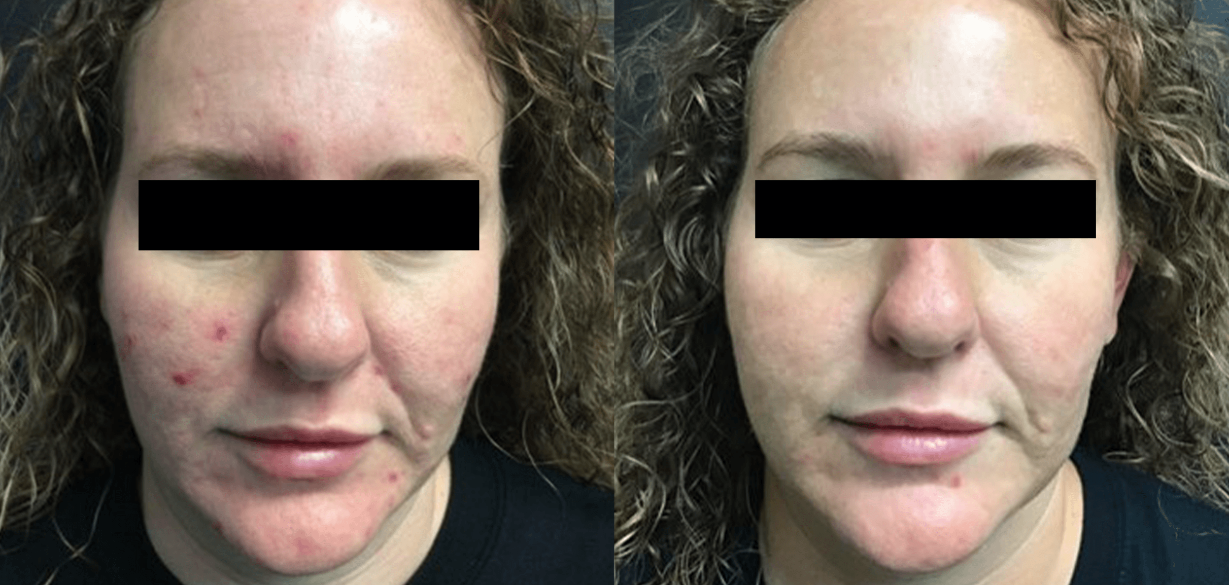 Before and after acne treatment with Laser Genesis at Define Clinic Brisbane