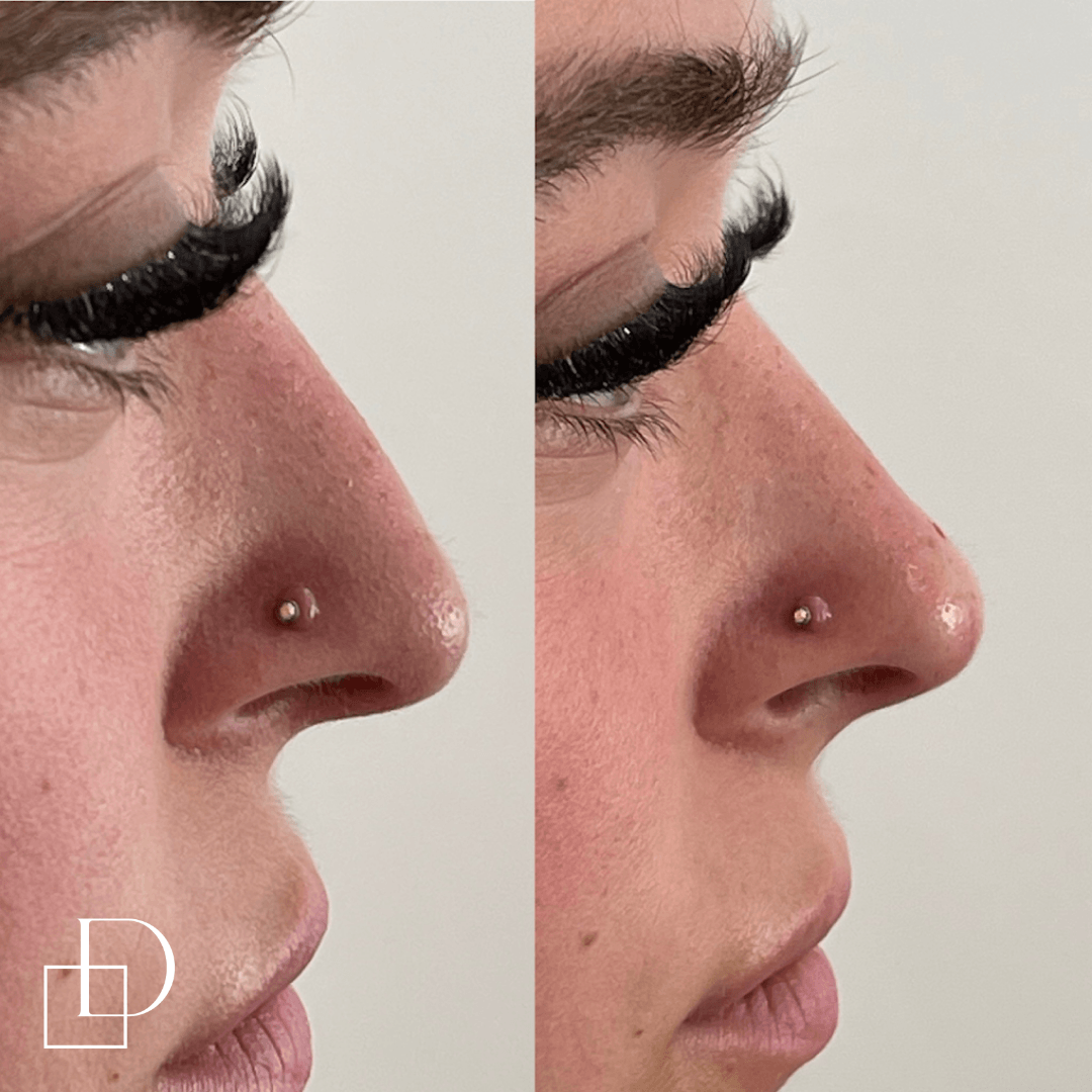 Before and after non-surgical rhinoplasty nose filler at Define Clinic Brisbane