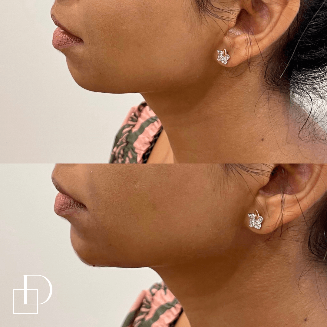 Before and after chin filler injections at Define Clinic Brisbane