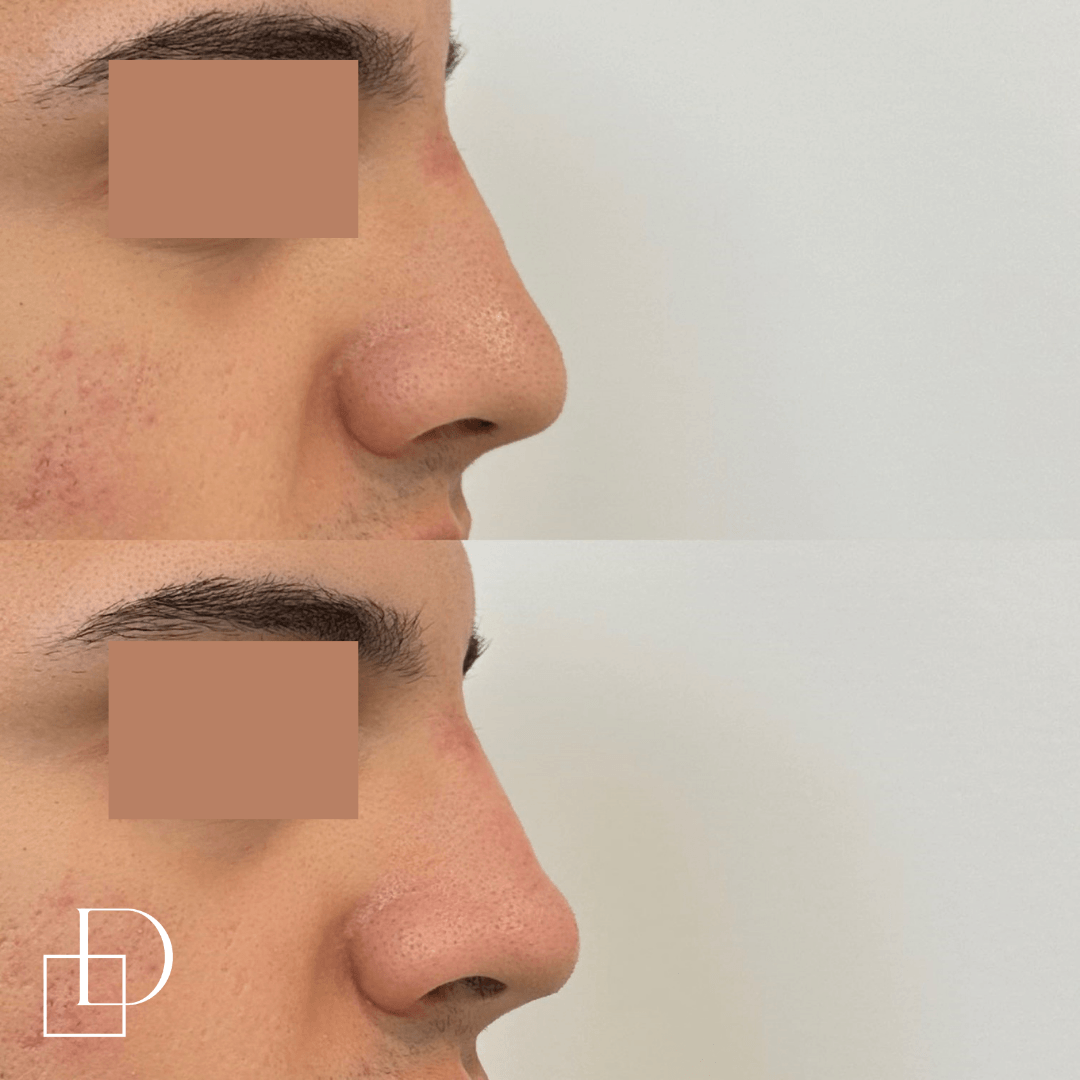 Before and after non-surgical rhinoplasty nose filler at Define Clinic Brisbane