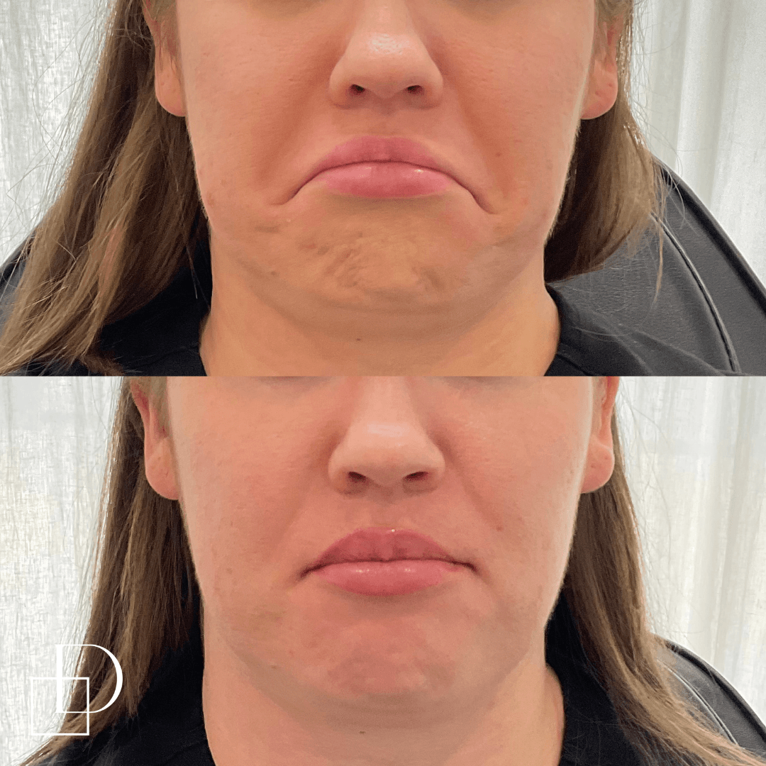 Before and after botox anti-wrinkle at Define Clinic Brisbane