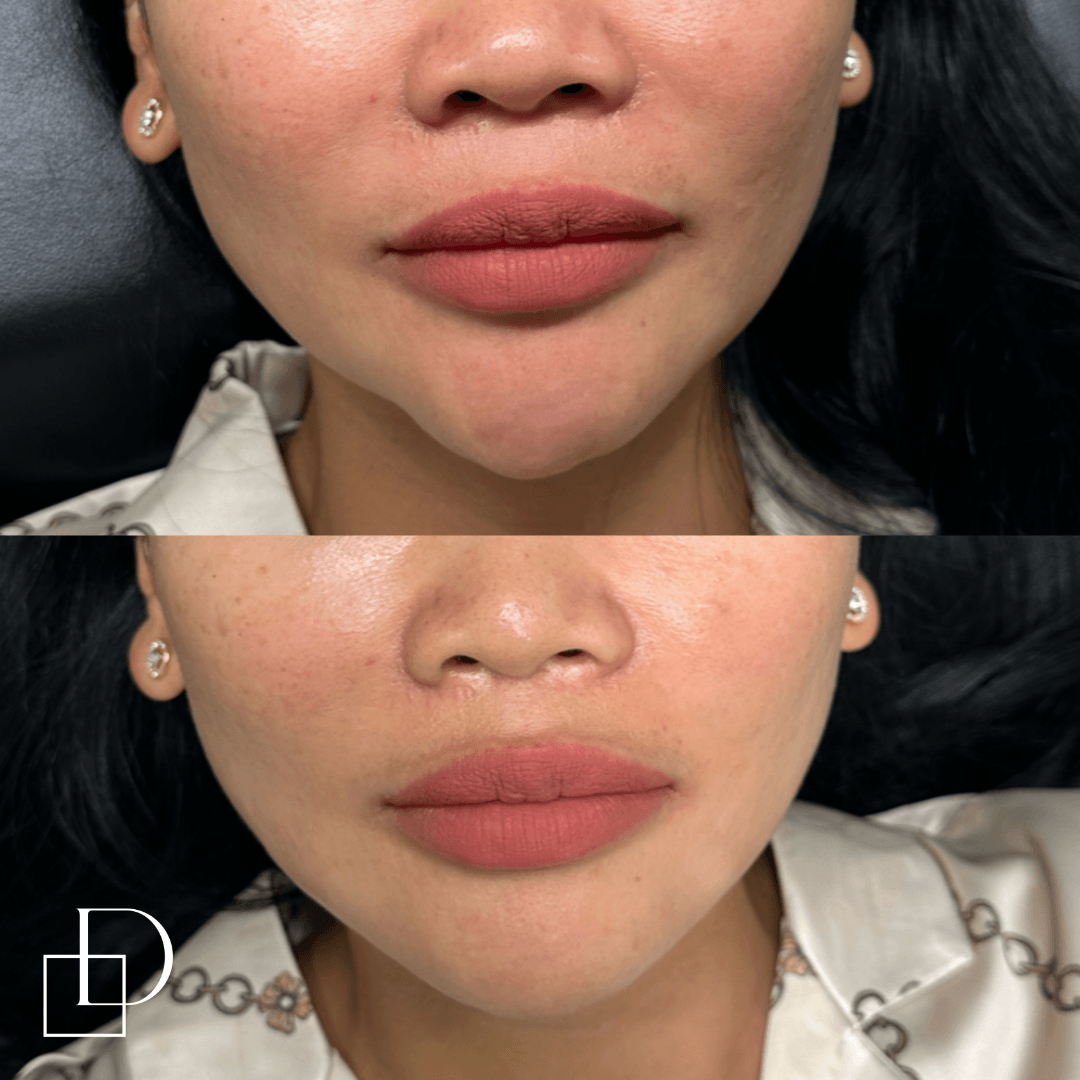 Before and after chin filler injections at Define Clinic Brisbane