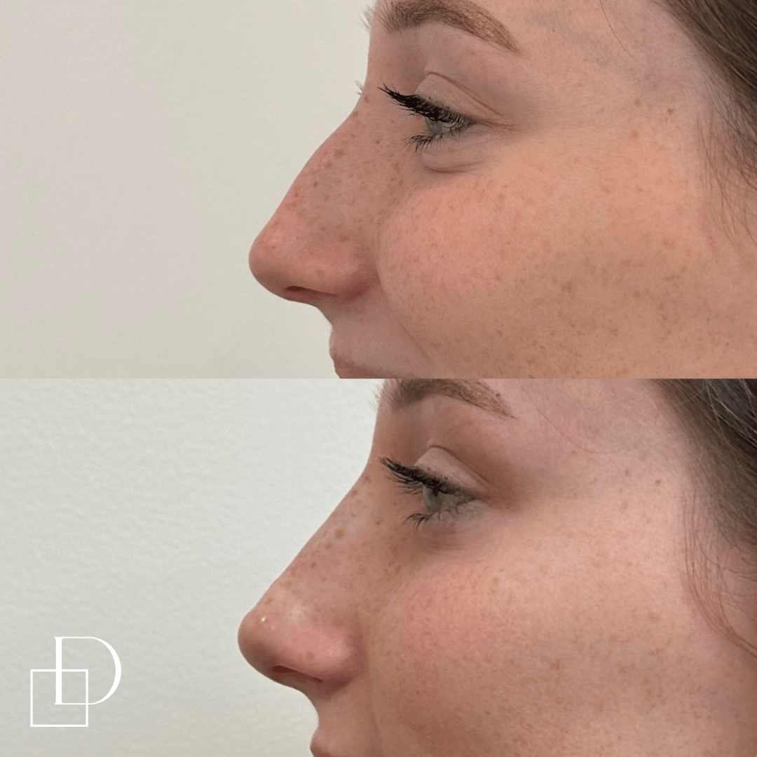 Before and after non-surgical rhinoplasty nose filler at Define Clinic Brisbane
