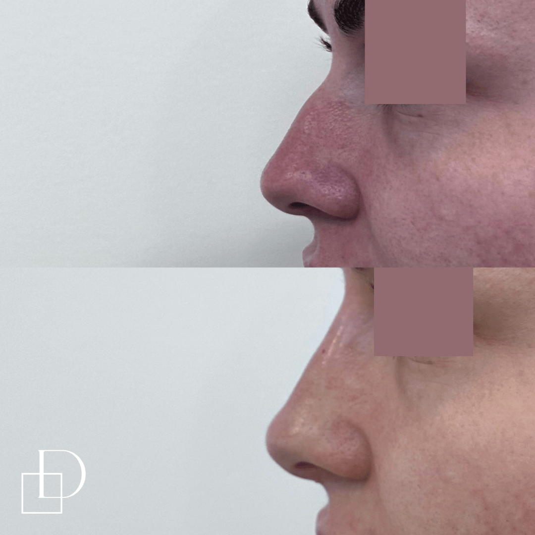 Before and after non-surgical rhinoplasty nose filler at Define Clinic Brisbane