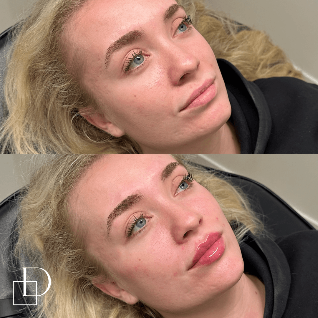 Before and after lip filler injections at Define Clinic Brisbane