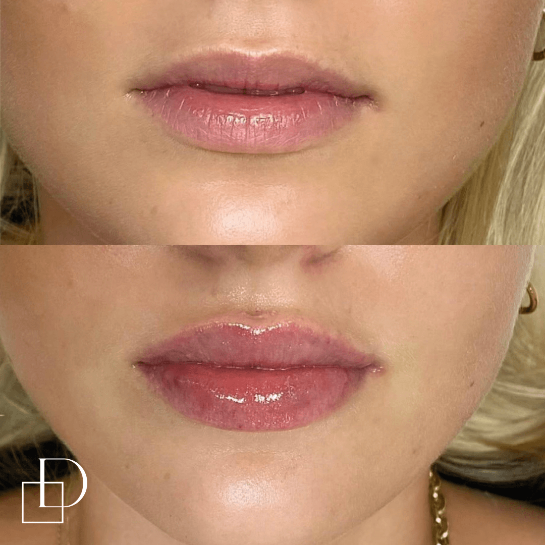 Before and after lip filler injections at Define Clinic Brisbane