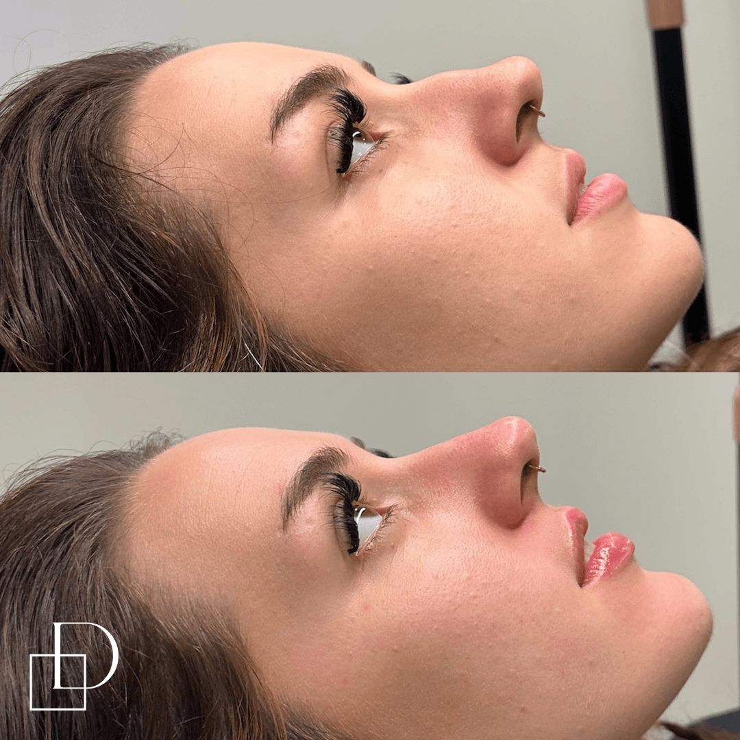 Before and after non-surgical rhinoplasty nose filler at Define Clinic Brisbane