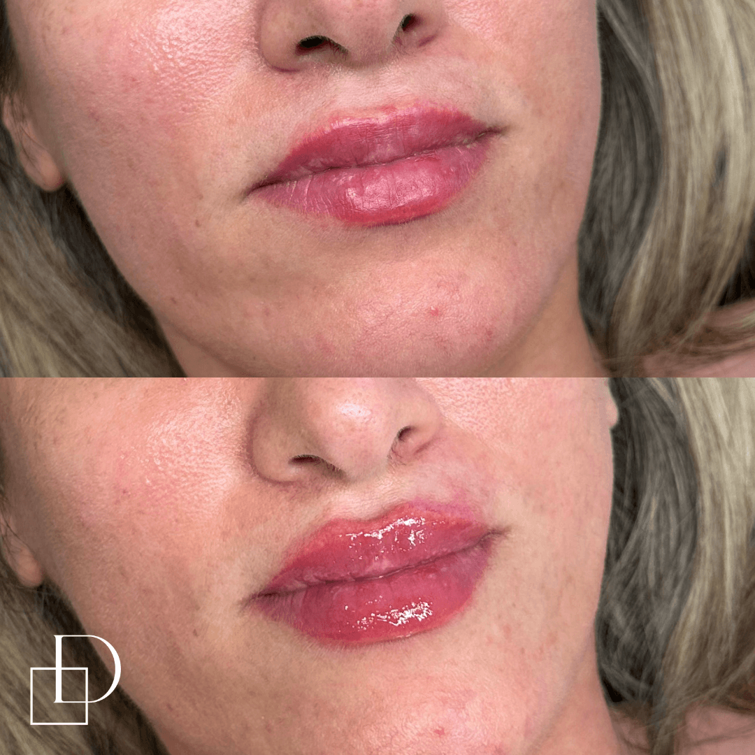 Before and after lip filler injections at Define Clinic Brisbane