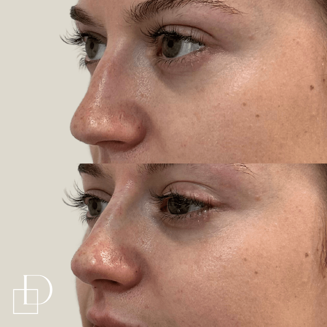Before and after non-surgical rhinoplasty nose filler at Define Clinic Brisbane
