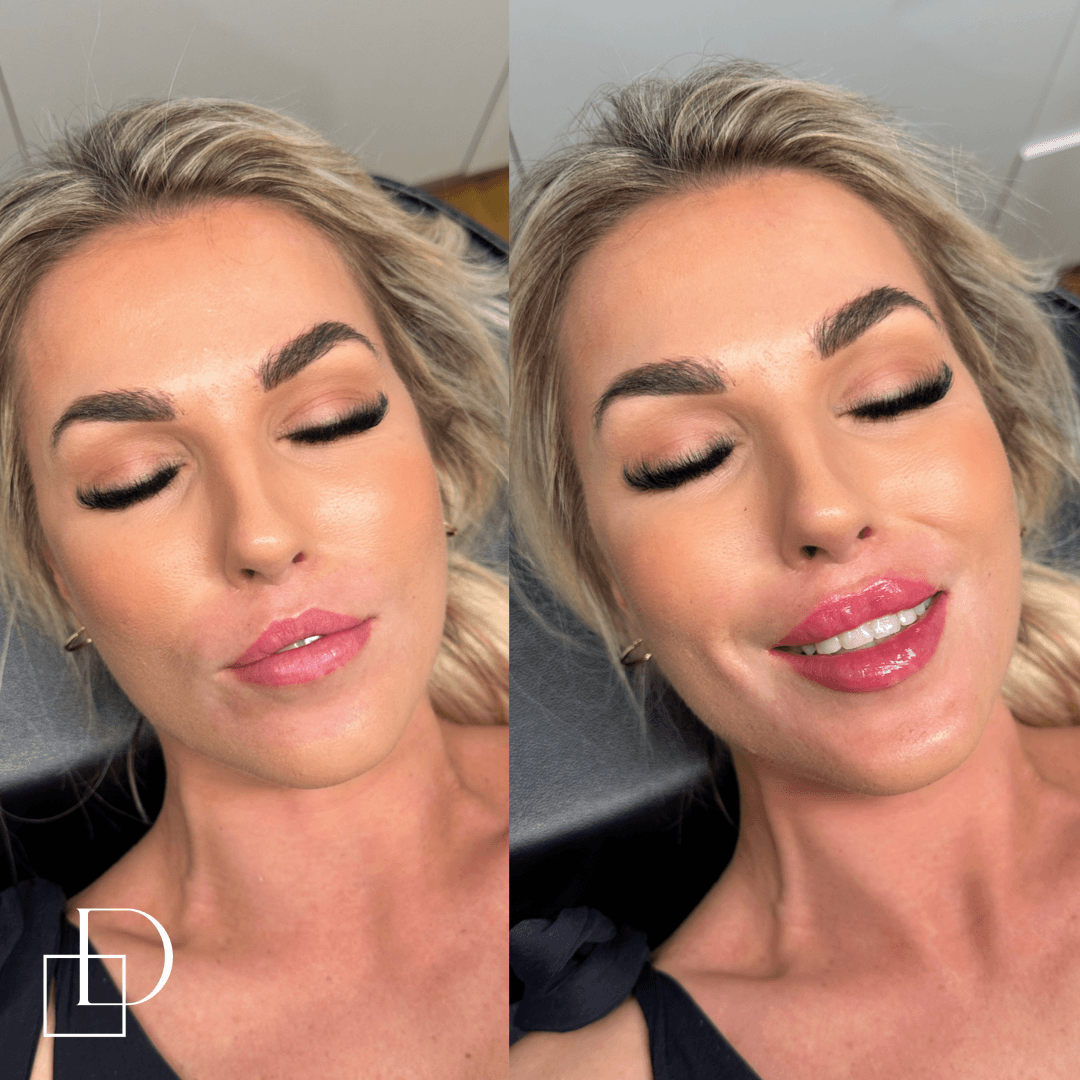 Before and after lip filler injections at Define Clinic Brisbane