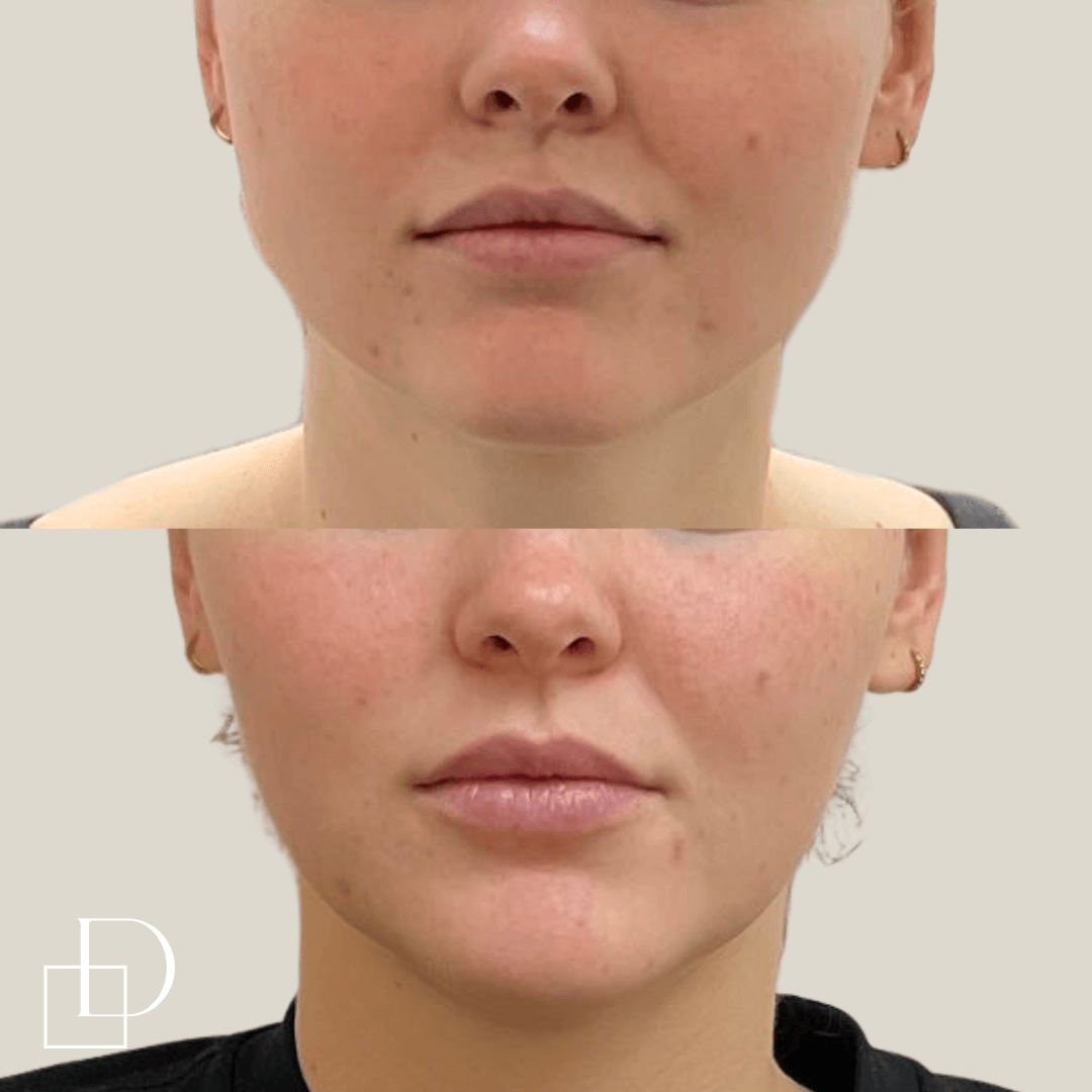 Before and after masseters botox at Define Clinic Brisbane