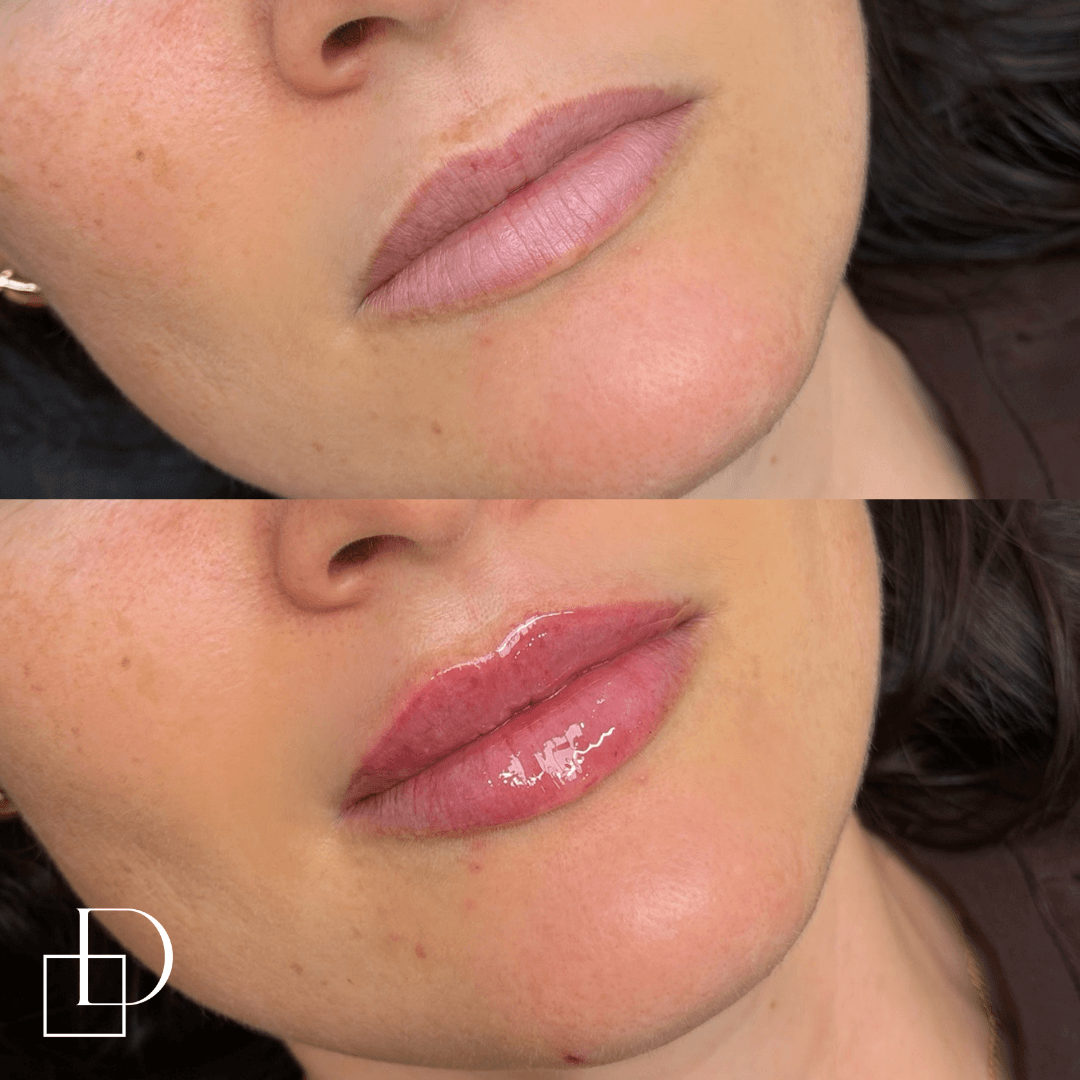 Before and after lip filler injections at Define Clinic Brisbane