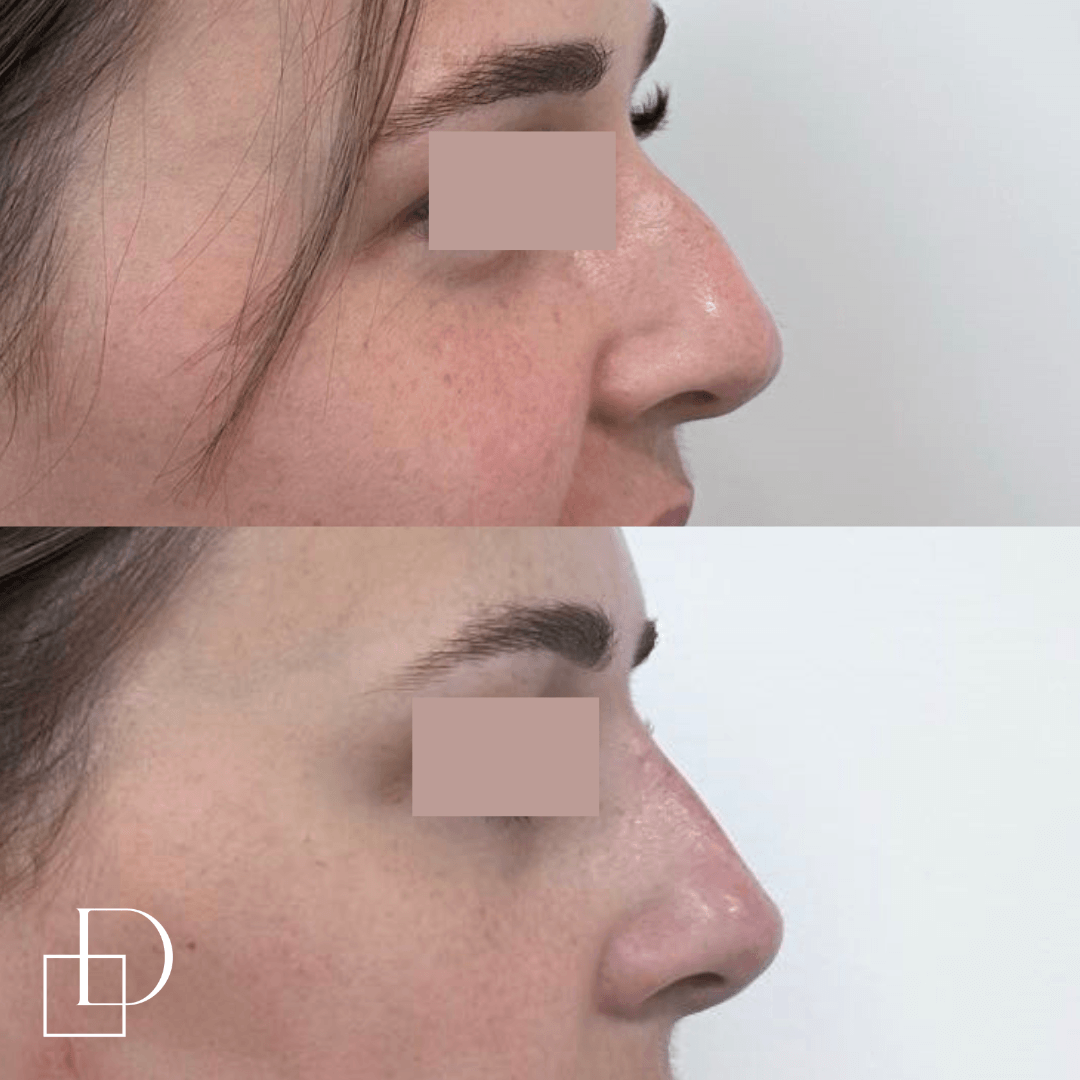 Before and after non-surgical rhinoplasty nose filler at Define Clinic Brisbane