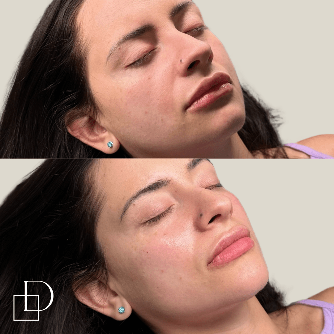 Before and after cosmetic cheek dermal filler injections at Define Clinic Brisbane