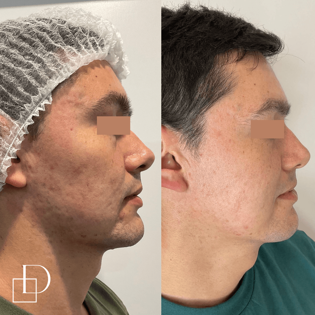Before and after acne treatment with Laser Genesis at Define Clinic Brisbane