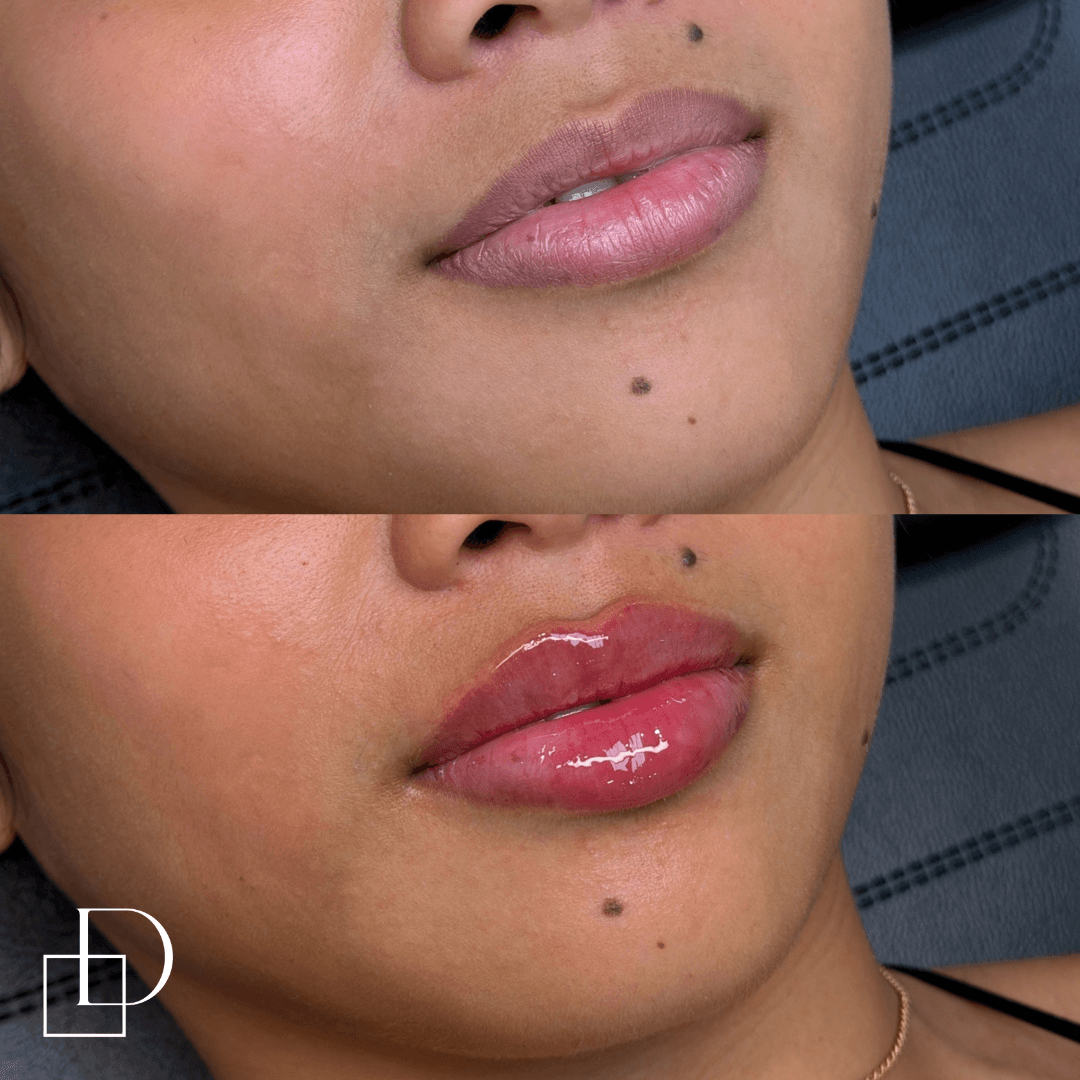 Before and after lip filler injections at Define Clinic Brisbane