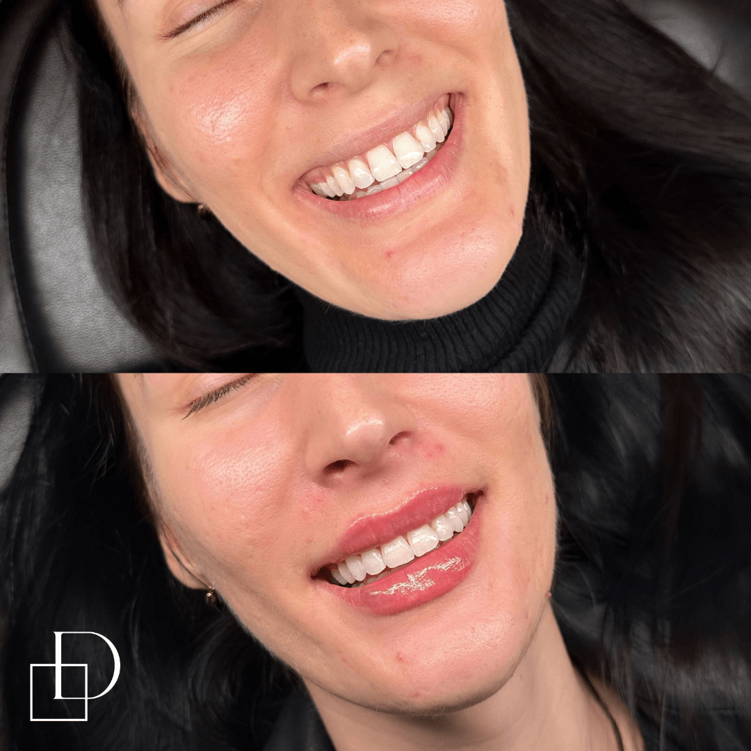 Before and after lip filler injections at Define Clinic Brisbane