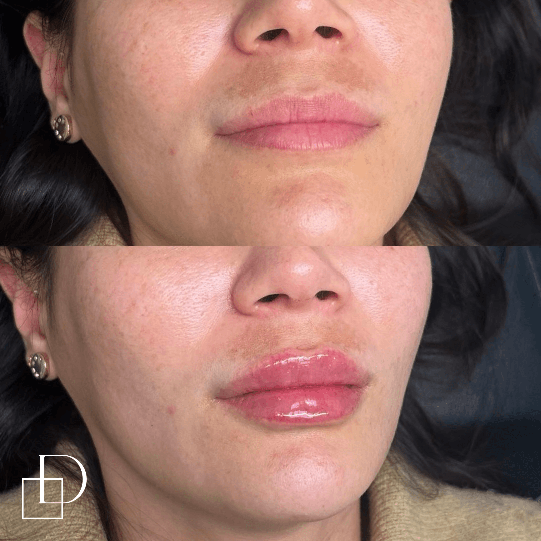 Before and after lip filler injections at Define Clinic Brisbane