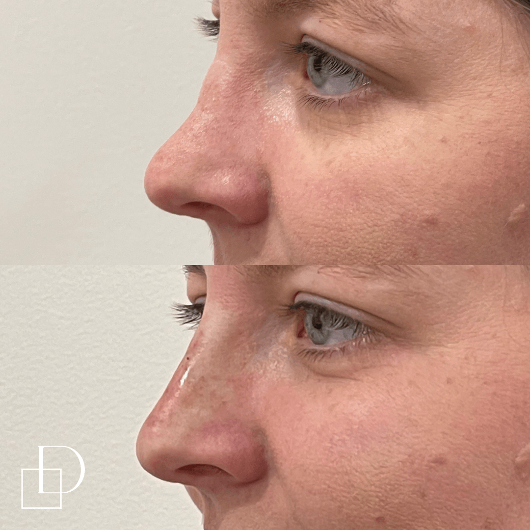 Before and after non-surgical rhinoplasty nose filler at Define Clinic Brisbane