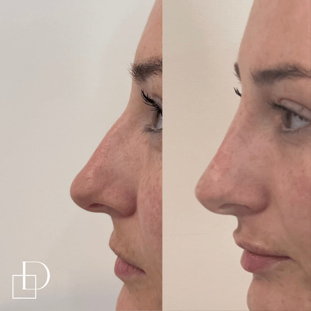 Before and after non-surgical rhinoplasty nose filler at Define Clinic Brisbane
