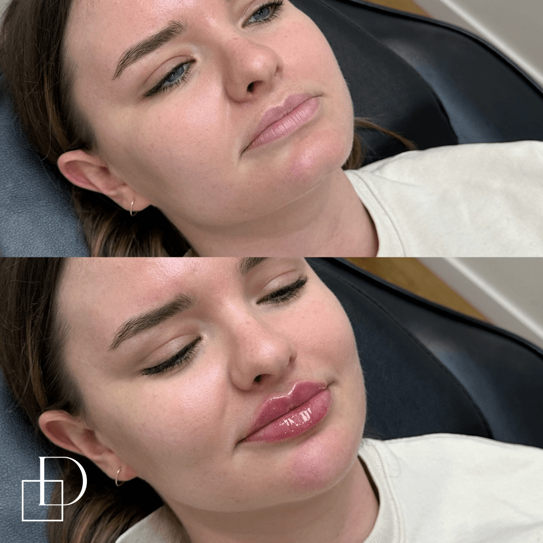 Before and after lip and chin filler injections at Define Clinic Brisbane