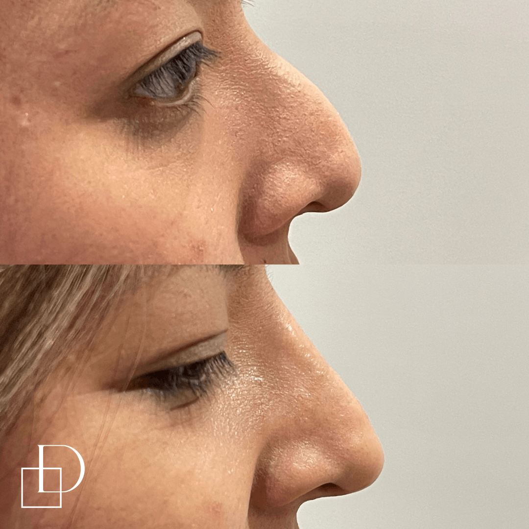 Before and after non-surgical rhinoplasty nose filler at Define Clinic Brisbane