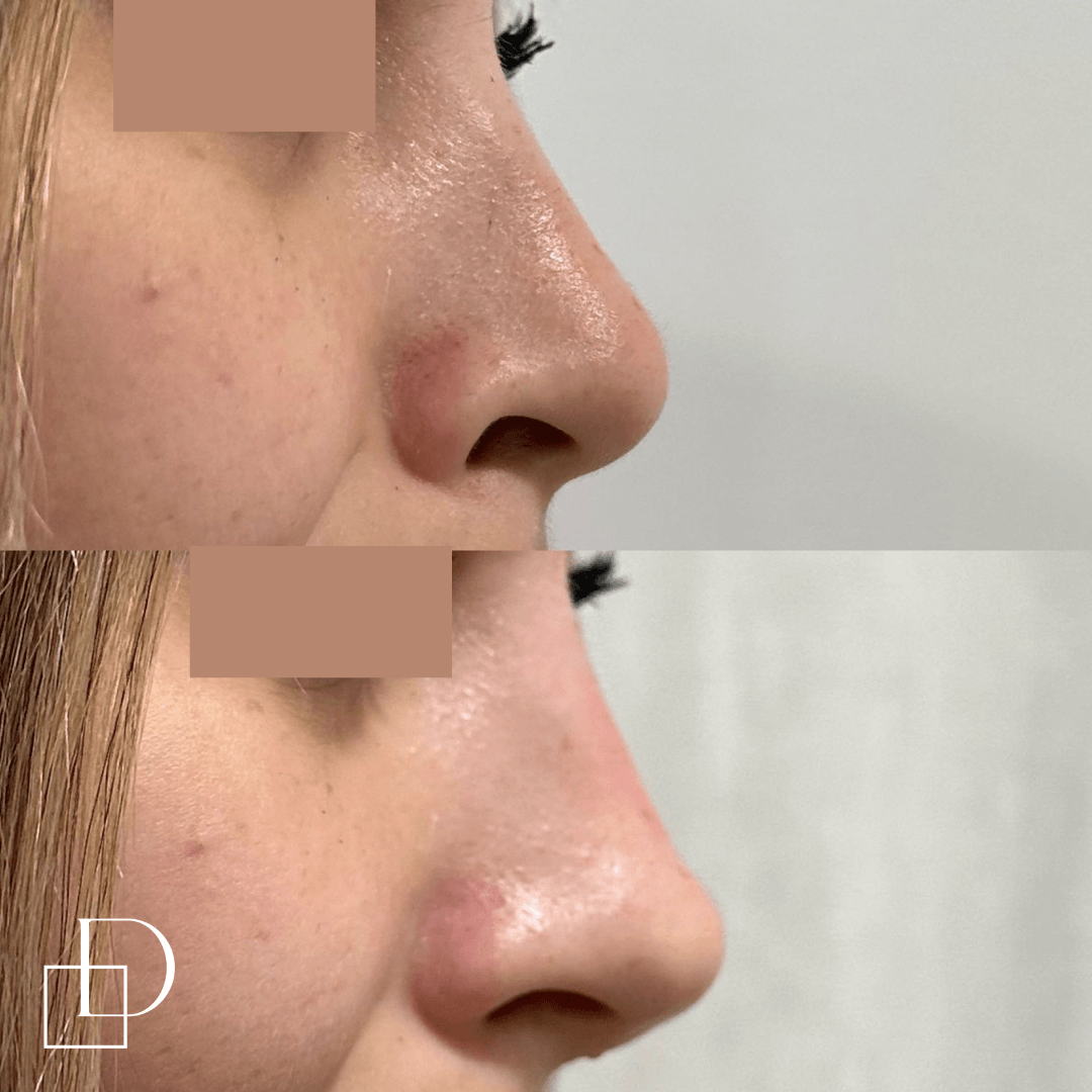 Before and after non-surgical rhinoplasty nose filler at Define Clinic Brisbane
