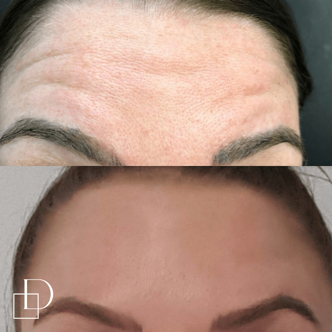 Before and after forehead botox anti-wrinkle at Define Clinic Brisbane