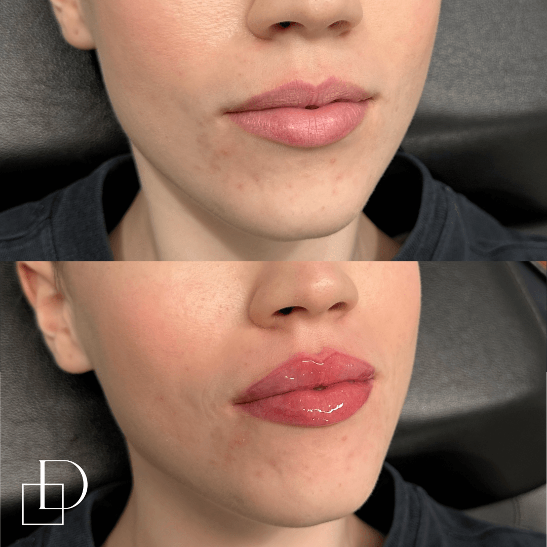 Before and after lip filler injections at Define Clinic Brisbane