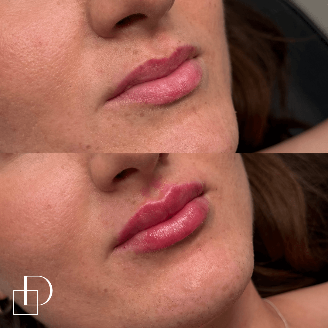 Before and after lip filler injections at Define Clinic Brisbane