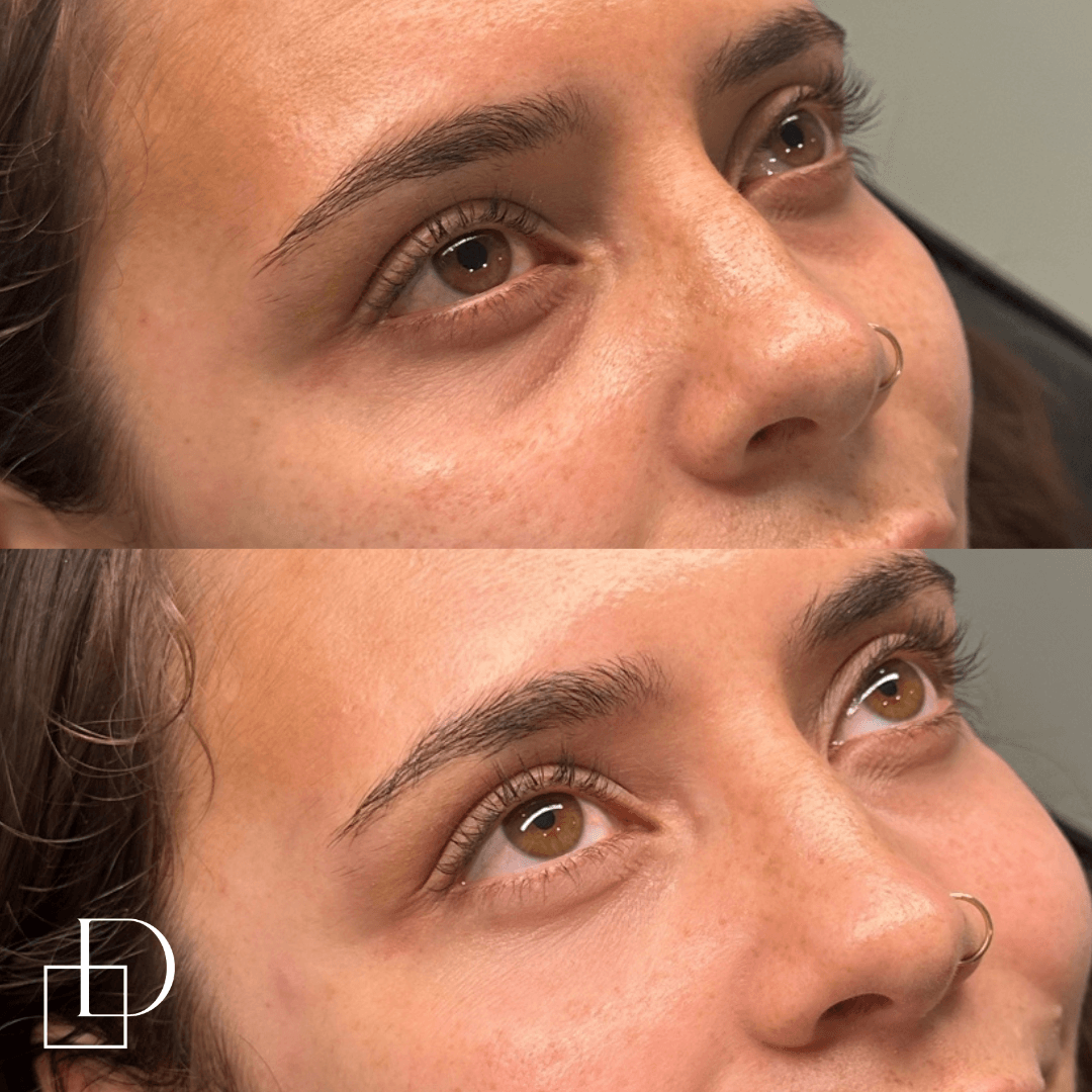 Before and after tear trough under eye filler injections at Define Clinic Brisbane