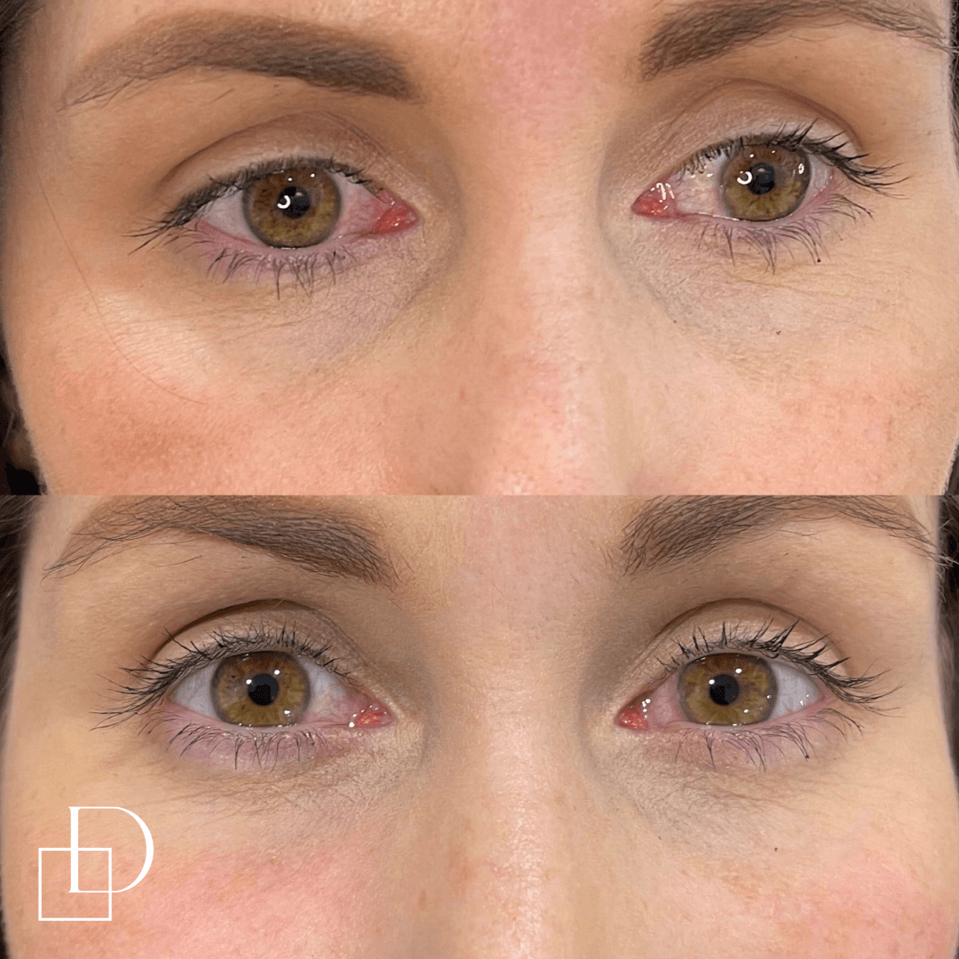 Before and after tear trough under eye filler injections at Define Clinic Brisbane
