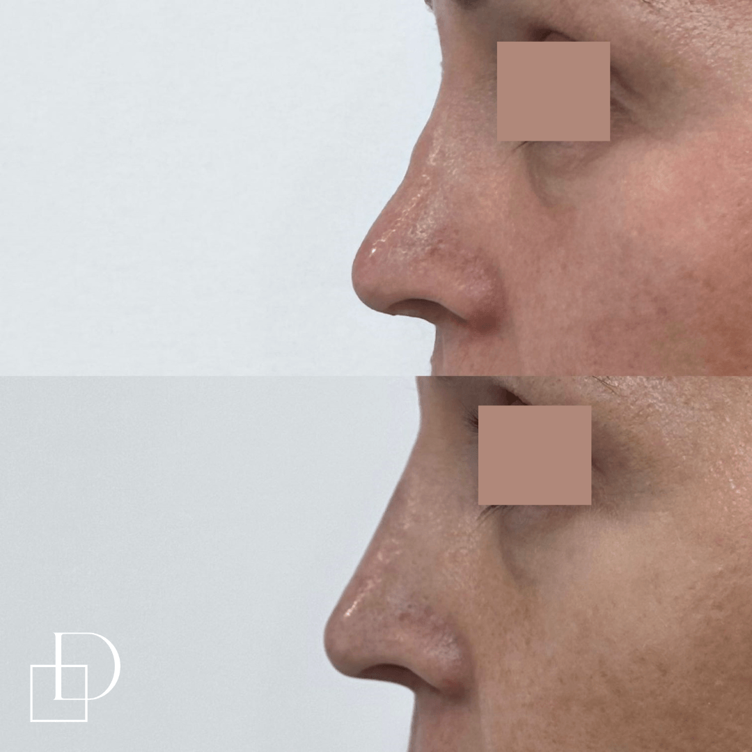Before and after non-surgical rhinoplasty nose filler at Define Clinic Brisbane