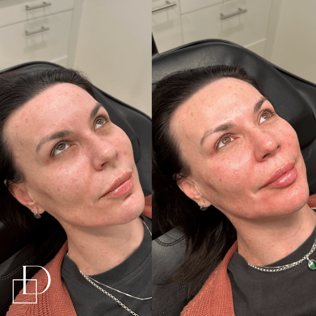 Before and after tear trough under eye filler injections at Define Clinic Brisbane