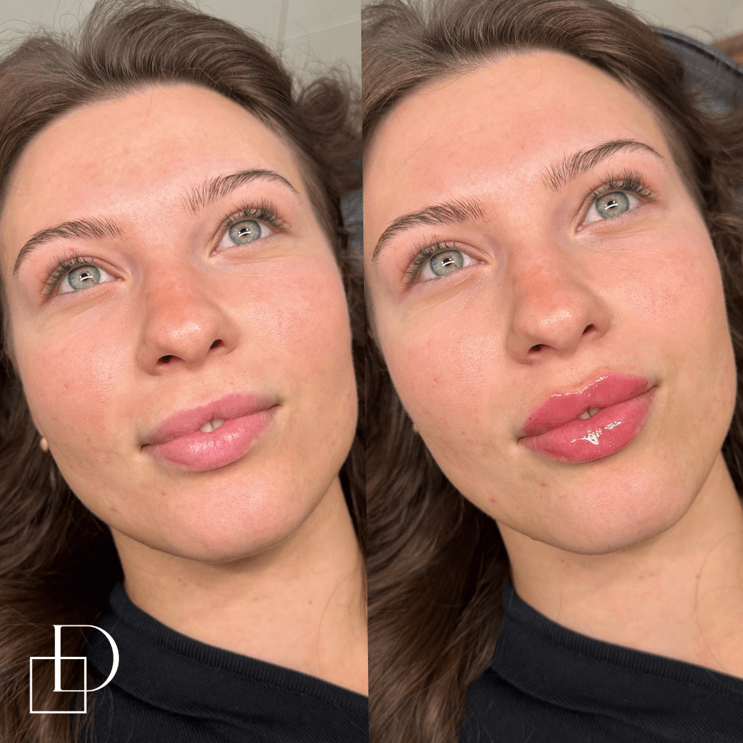 Before and after lip filler injections at Define Clinic Brisbane