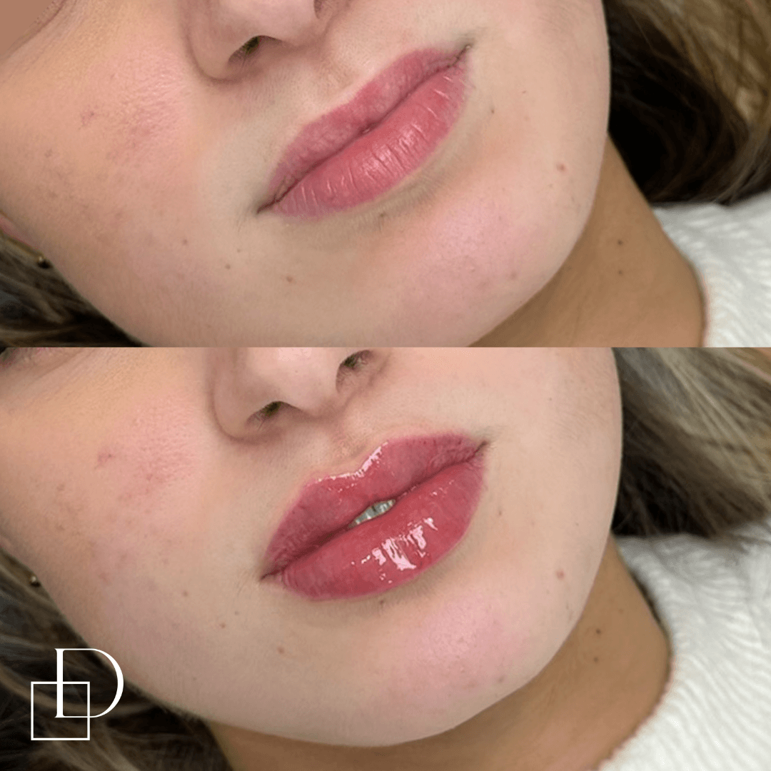 Before and after lip filler injections at Define Clinic Brisbane