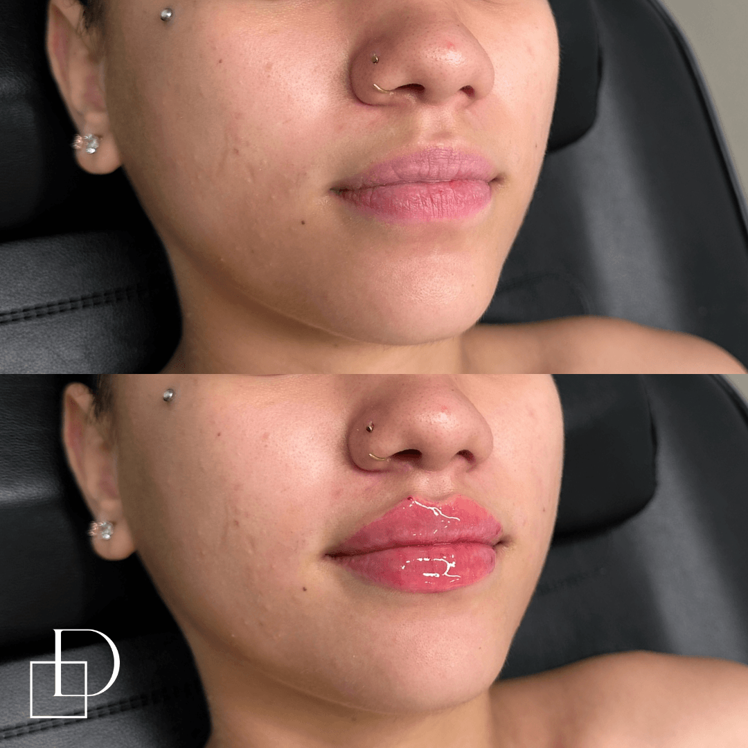 Before and after lip filler injections at Define Clinic Brisbane