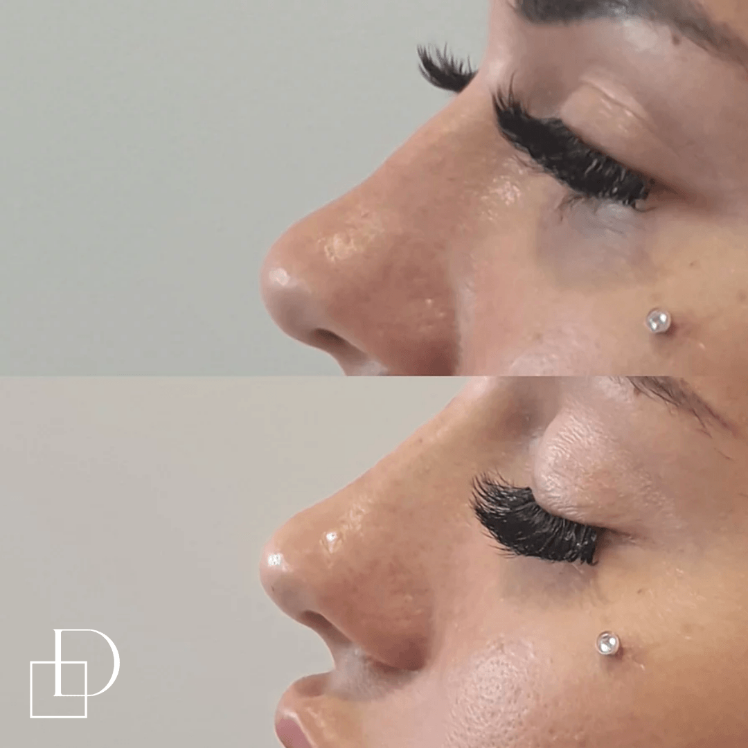 Before and after non-surgical rhinoplasty nose filler at Define Clinic Brisbane