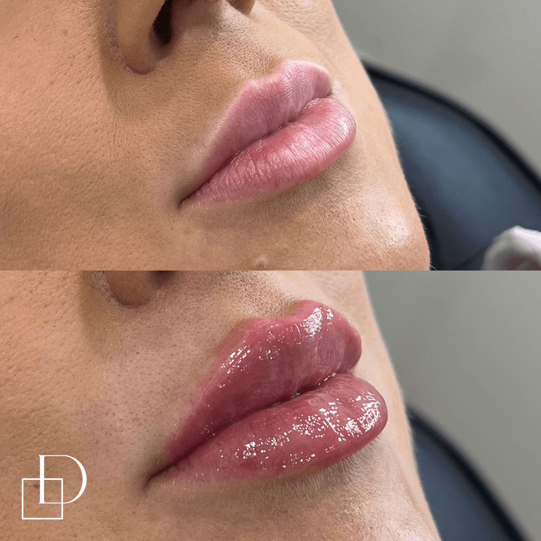 Before and after lip filler injections at Define Clinic Brisbane