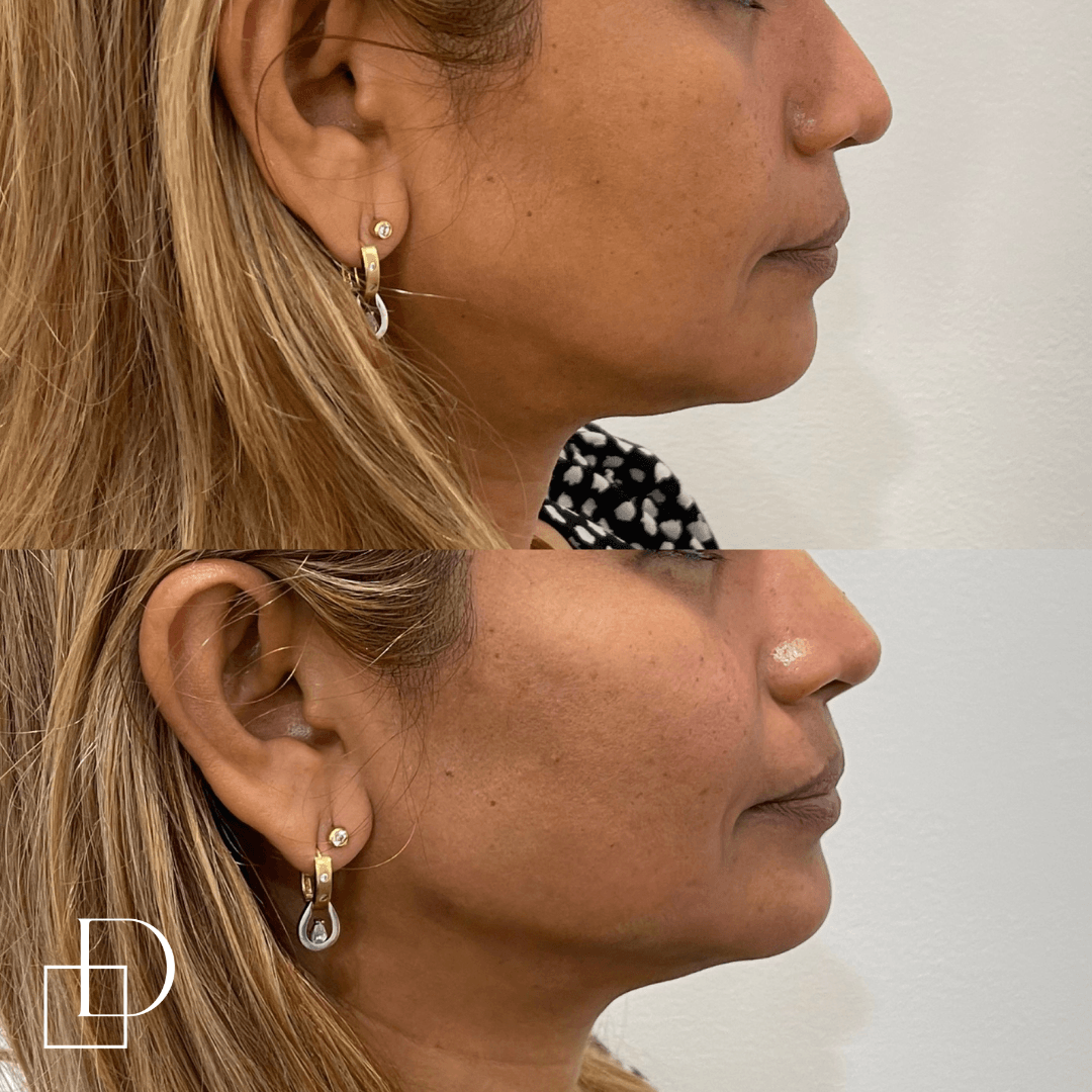 Before and after jawline filler injections at Define Clinic Brisbane