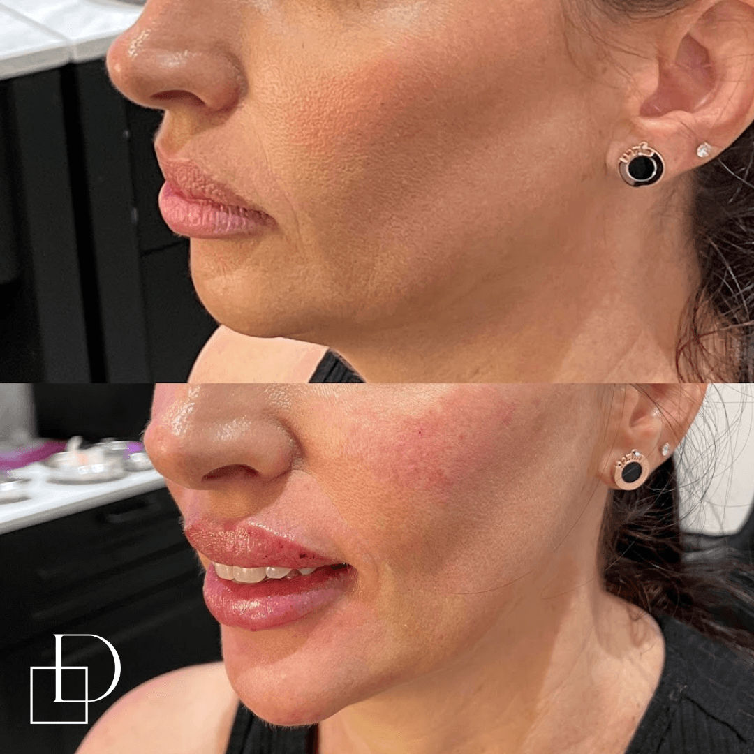 Before and after jawline filler injections at Define Clinic Brisbane