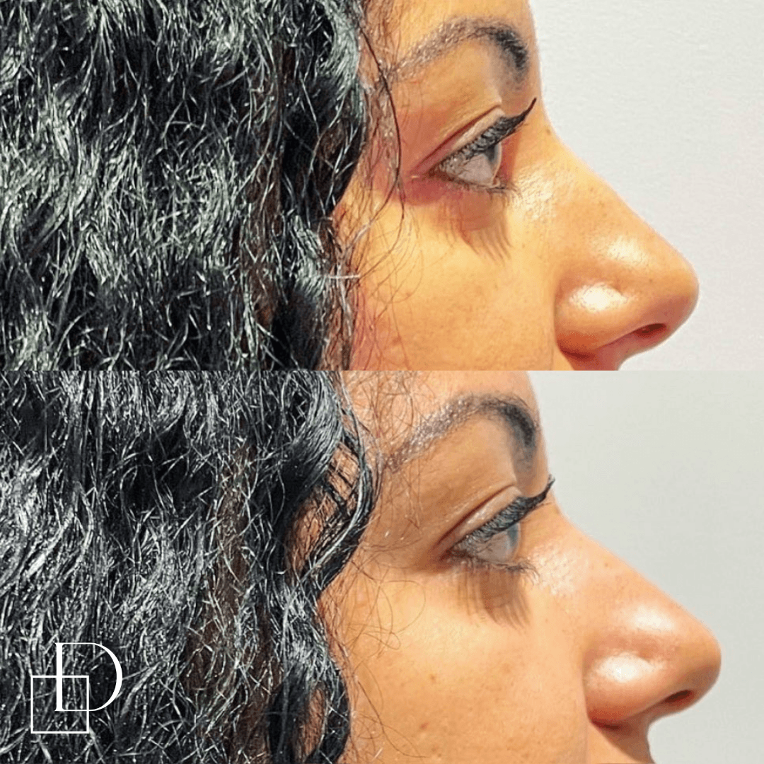 Before and after non-surgical rhinoplasty nose filler at Define Clinic Brisbane