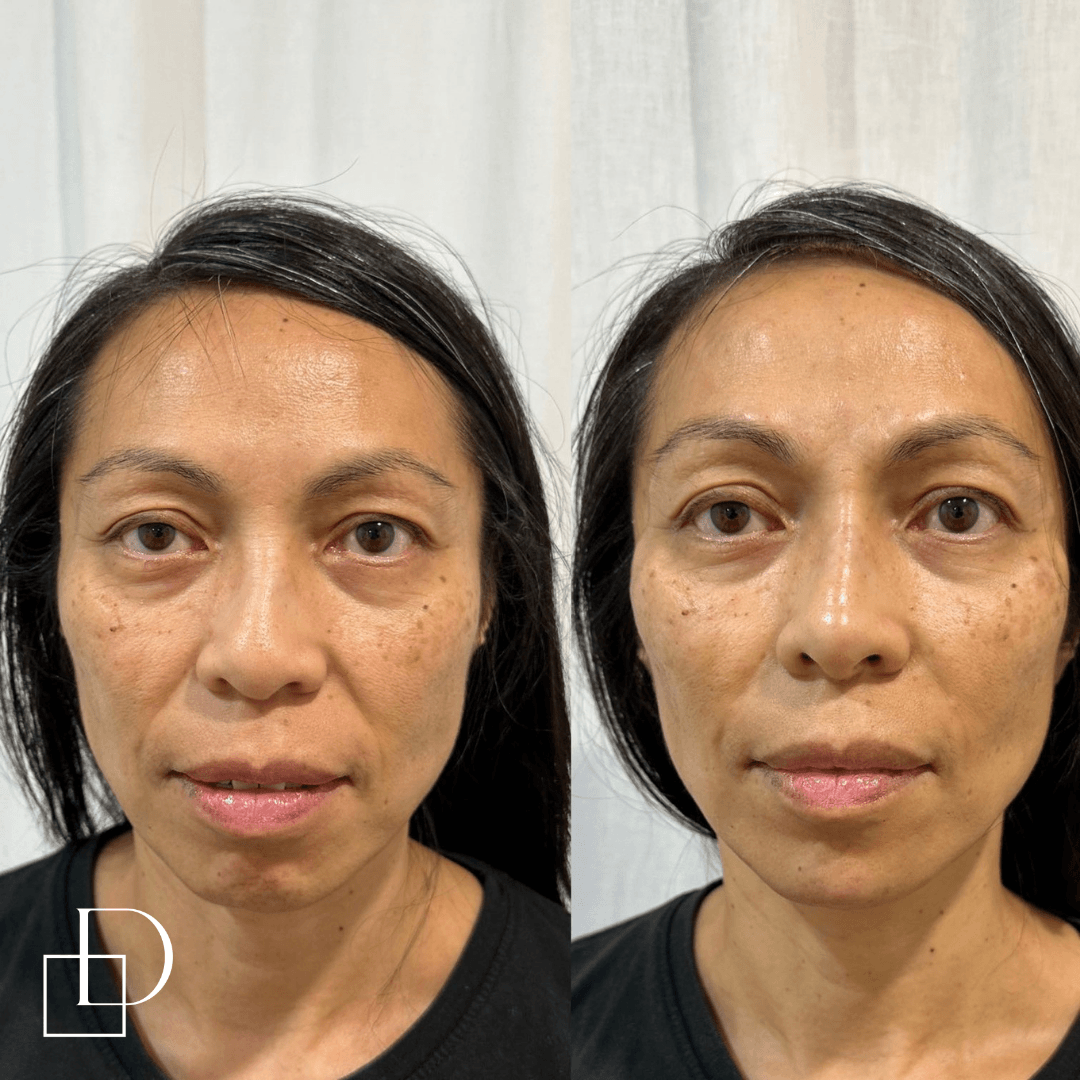 Before and after cheek filler injections at Define Clinic Brisbane