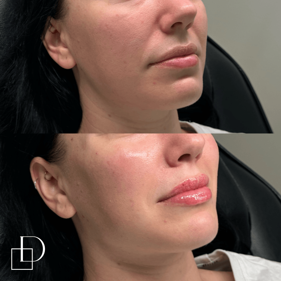 Before and after cheek filler injections at Define Clinic Brisbane