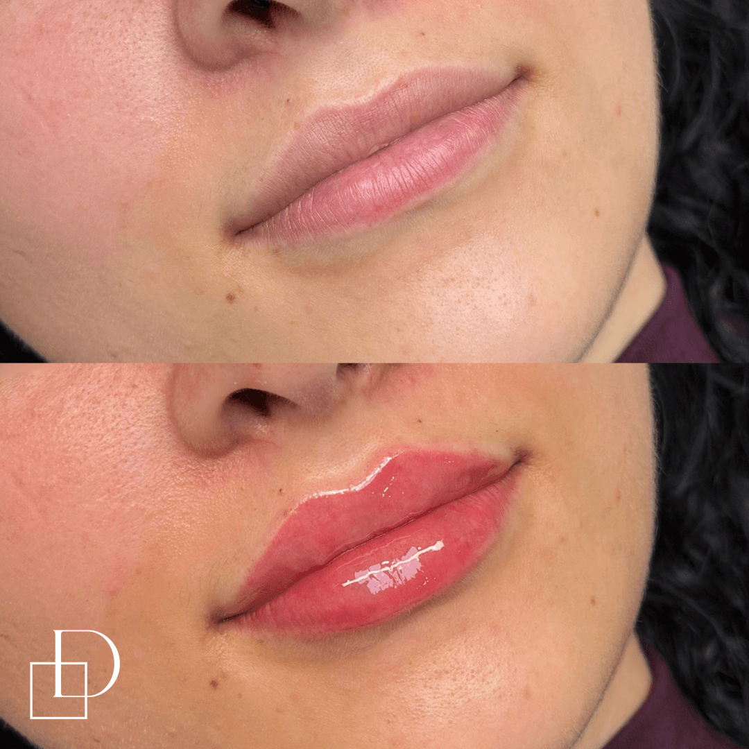 Before and after lip filler injections at Define Clinic Brisbane