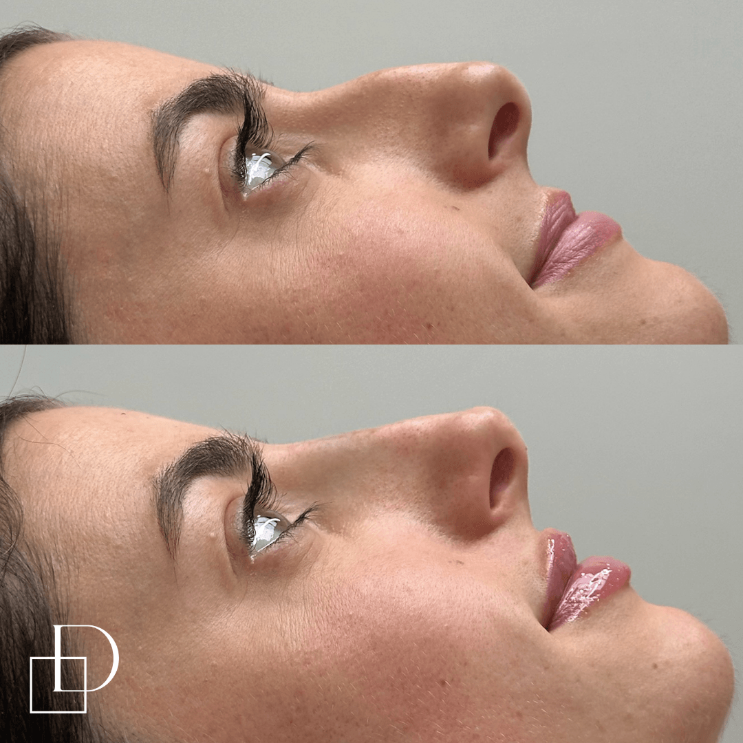 Before and after non-surgical rhinoplasty nose filler at Define Clinic Brisbane