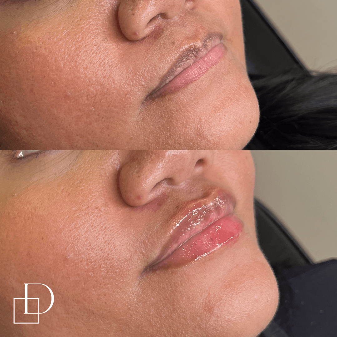 Before and after lip filler injections at Define Clinic Brisbane