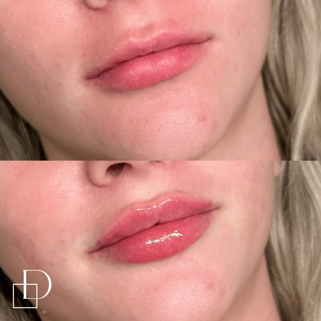 Before and after lip filler injections at Define Clinic Brisbane