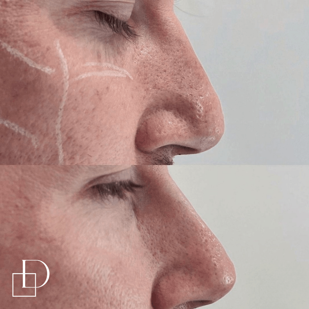 Before and after non-surgical rhinoplasty nose filler at Define Clinic Brisbane
