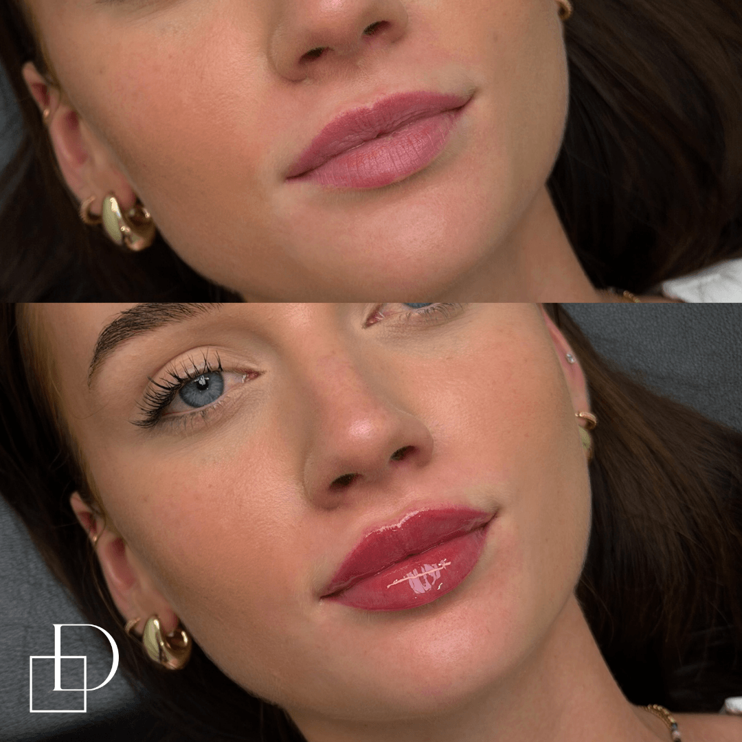 Before and after lip filler injections at Define Clinic Brisbane